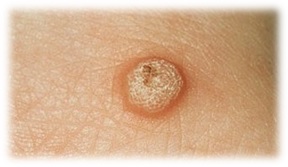 Common Wart